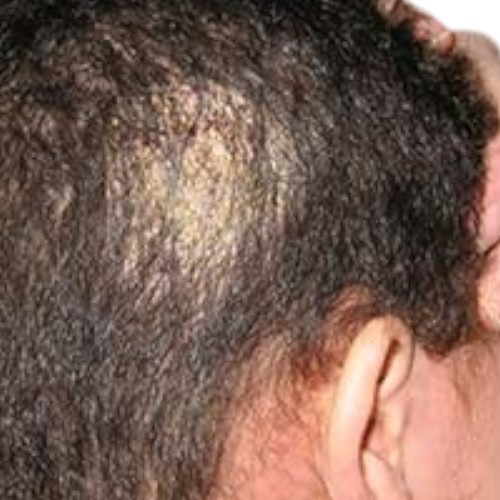 قشرة ناتجة عن الاصابة بتينيا كابيتس